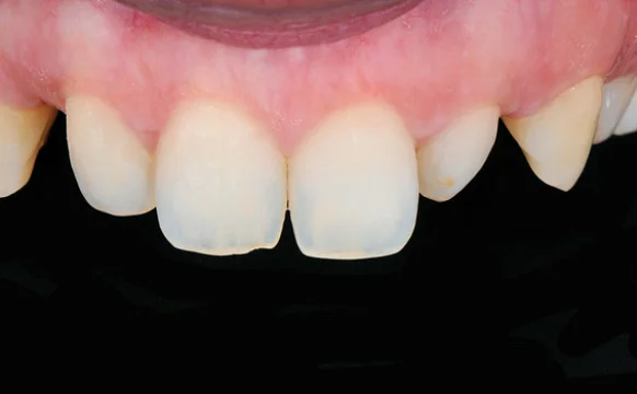 Восстановление эстетики винирами