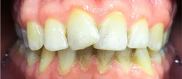 Исправление одностороннего дистального прикуса