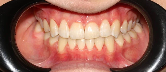 Ортодонтическое лечение на элайнерах №1