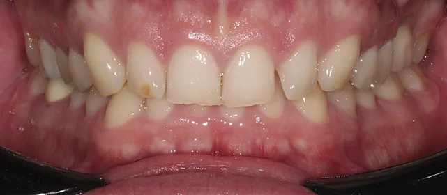 Односторонний второй класс смыкания: лечение