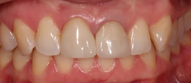 Замена старых композитных реставраций и металлокерамических коронок на керамические накладки и коронки