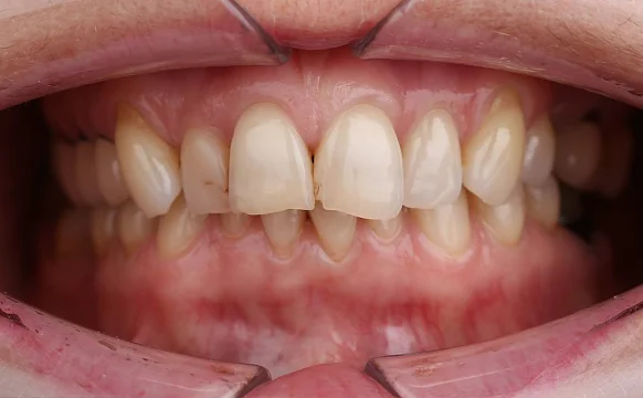 Лечение скученности зубов на брекет-системе