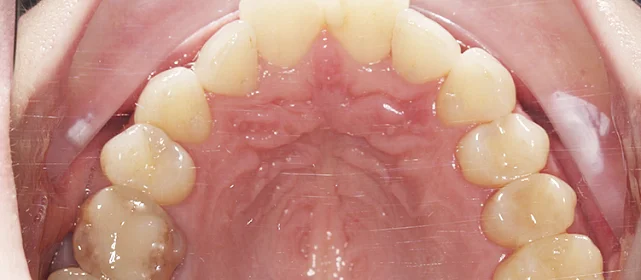 Исправление скученности на элайнерах