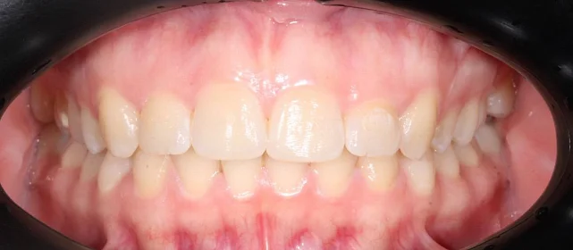 Лечение cкученности на нижней челюсти на элайнерах