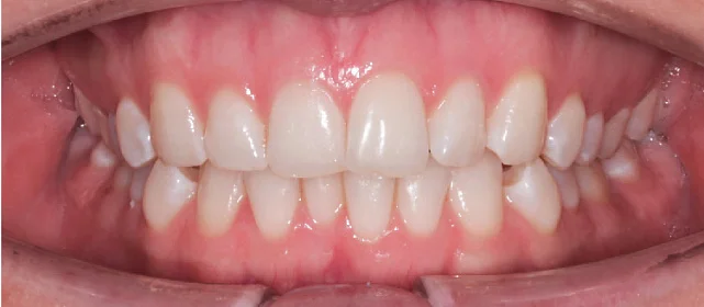 Исправление прикуса. 29 кап, 14 месяцев лечения