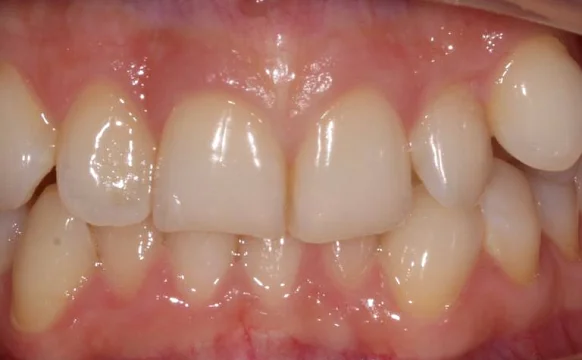 Ортодонтическое лечение на элайнерах №7