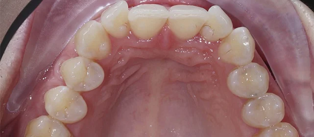 Изменение скученности зубов с помощью системы Invisalign