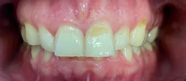 Ортодонтическое лечение №4