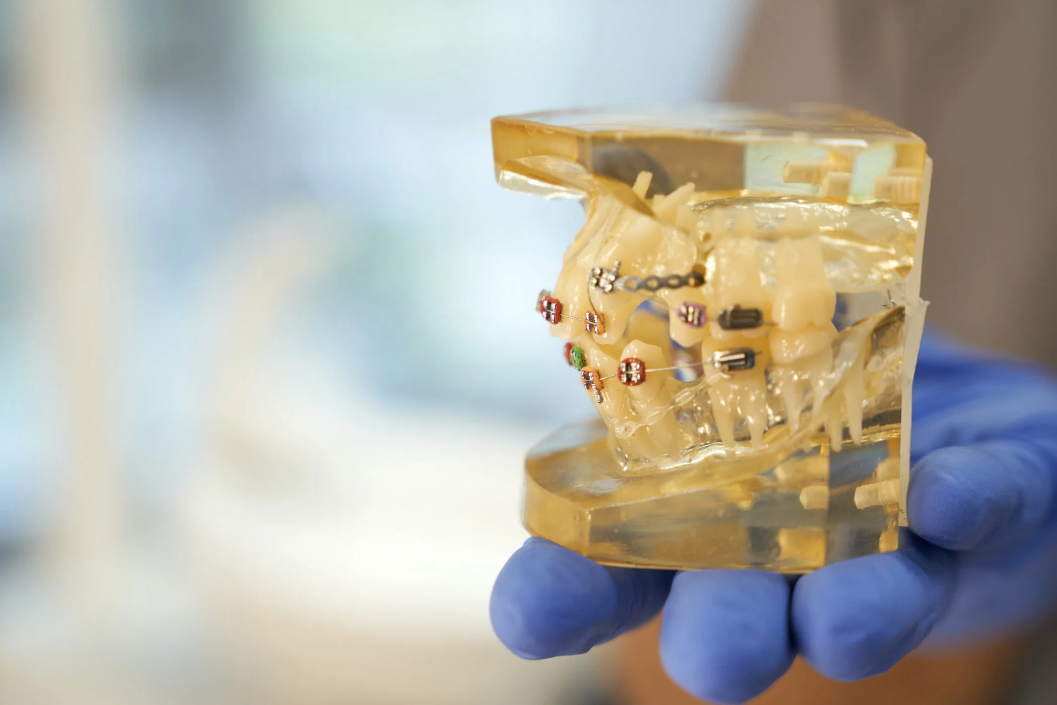 Мезиальный прикус