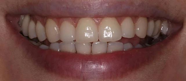 Отбеливание системой Zoom 4