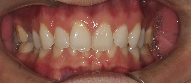 Исправление скученности зубов на верхней и нижней челюсти