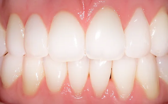 Выравнивание зубных рядов элайнерами Invisalign