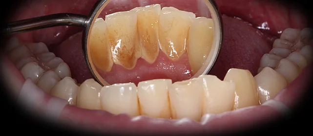 Удаление камней и профессиональная гигиена для последующего лечения кариеса