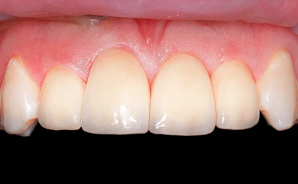 Восстановление эстетики с помощью виниров и вкладок (часть 1)