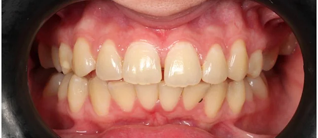 Ортодонтическое лечение на системе Click №5