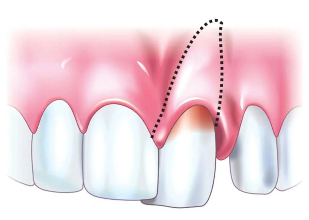 периодонтит зуба виды