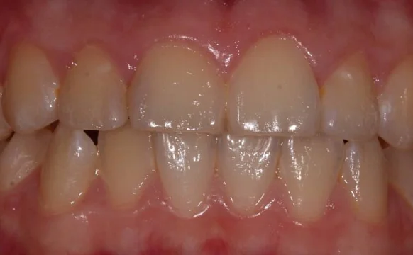 Ортодонтическое лечение на брекет-системе №3
