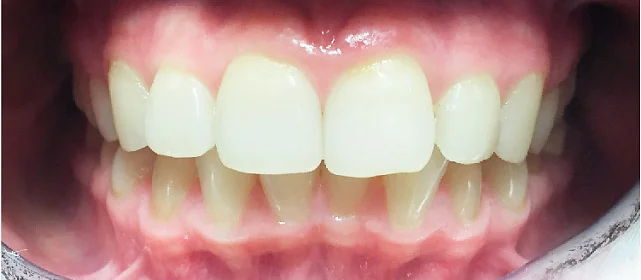 Лечение скученности зубов капами Инвизилайн