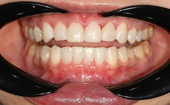 Ортодонтическое лечение на элайнерах №10