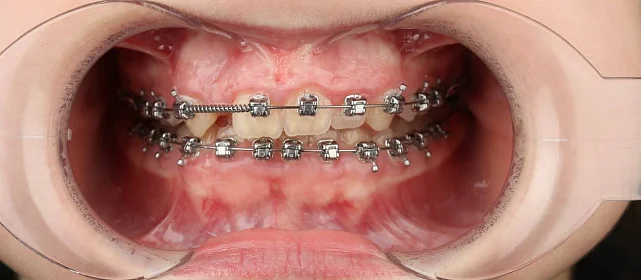 Лечение скученности зубов на брекет-системе