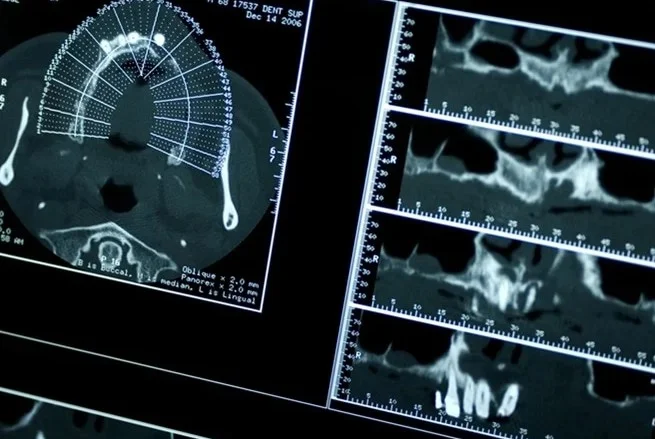 флюороз рентген