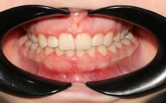 Лечение скученности зубов на брекет-системе