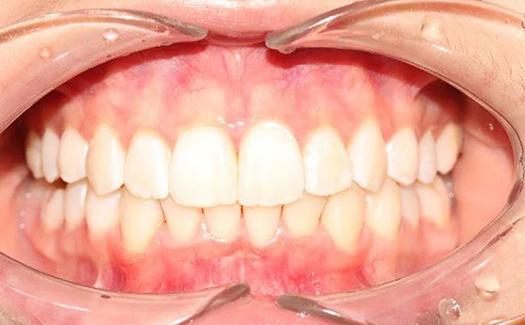 Ортодонтическое лечение на элайнерах №6