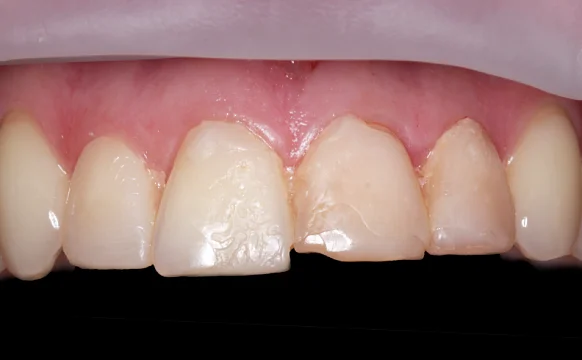 Устранение эстетического дефекта винирами