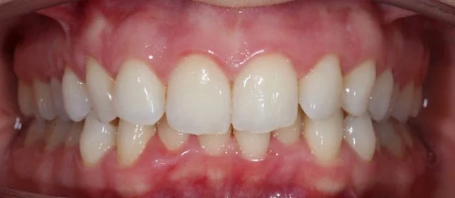 Лечение скученности зубов на элайнерах