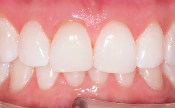 Исправление глубокого дистального прикуса