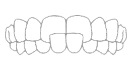 «Съехавший» ряд зубов