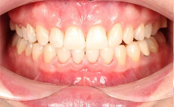 Коррекция дистальной окклюзия на брекет-системе