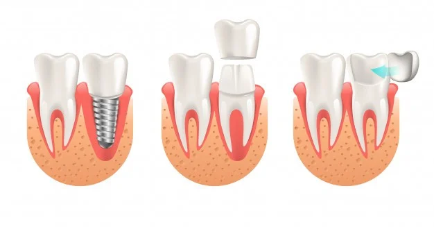 подготовка зуба к установке коронки