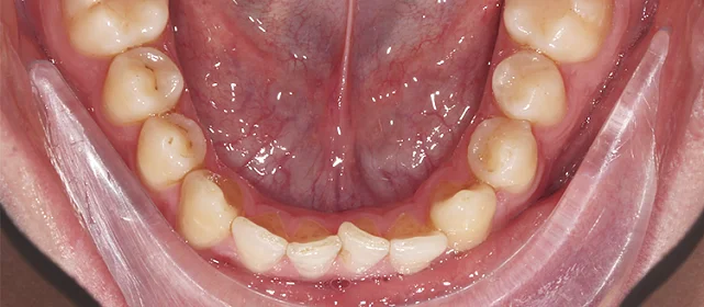 Нивелировка зубных рядов