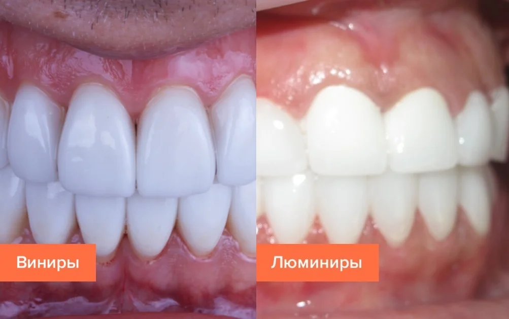 люминиры и виниры