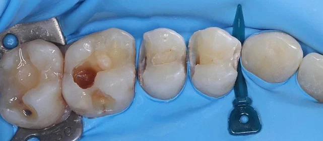 Реставрация задних зубов