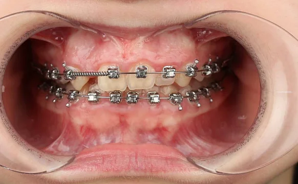 Лечение скученности зубов на брекет-системе