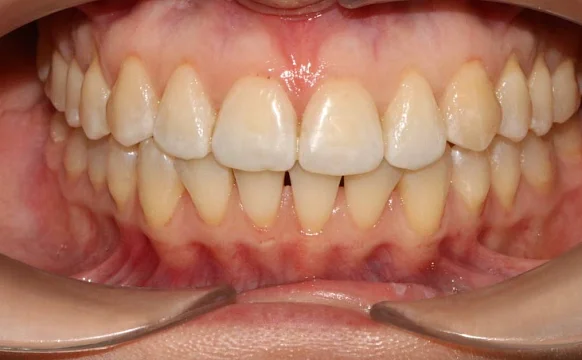 Лечение скученности зубов элайнерами