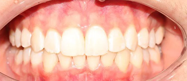 Ортодонтическое лечение на элайнерах №6