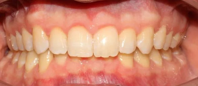 Ортодонтическое лечение на элайнерах №5