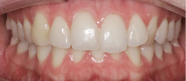 Расширение и выравнивание верхнего и нижнего зубных рядов