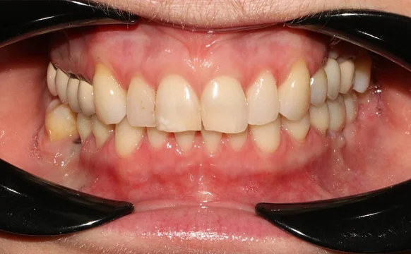 Лечение скученности зубов на брекет-системе