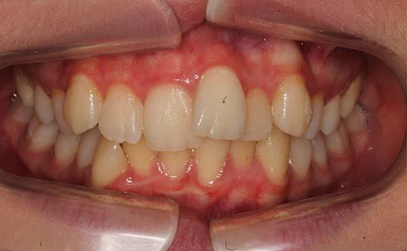 Ортодонтическое лечение на элайнерах №6