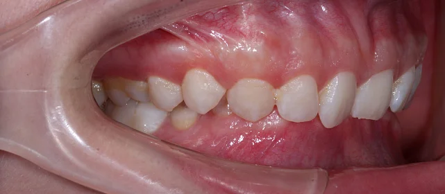 Лечение сужения ВЧ, скученности и дистального прикуса