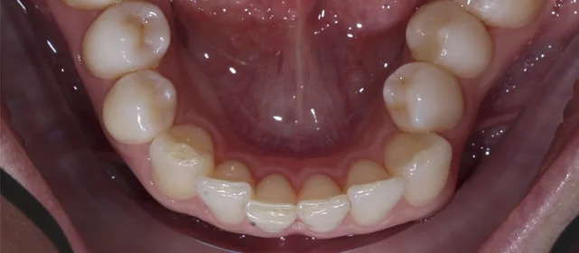 Лечение перекрестного смыкания в боковом сегменте