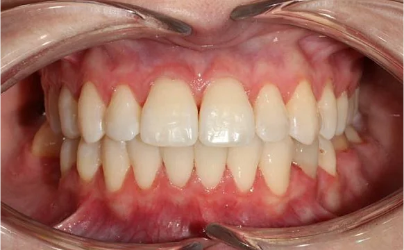 Лечение протрузии верхних резцов на брекет-системе