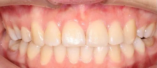 Ортодонтическое лечение на брекет-системе №1