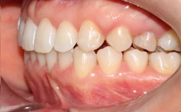 Ортодонтическое лечение на системе Click №1