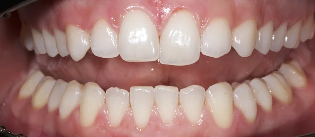 Коррекция уровня режущих краев 8