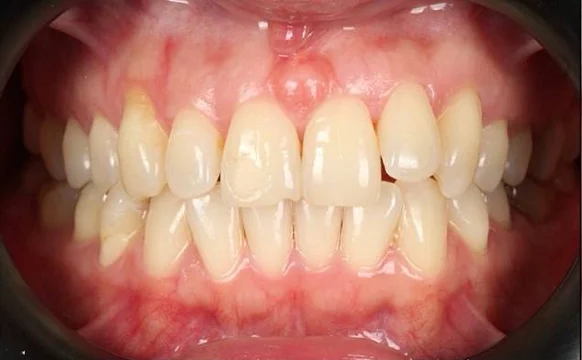 Лечение прикуса на брекет-системе